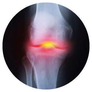 Arthritis Protocol Pack